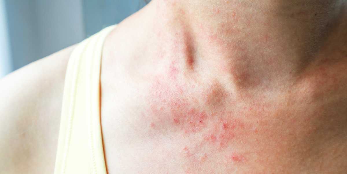 These Pictures Will Help You Identify the Most Common Skin Rashes b...